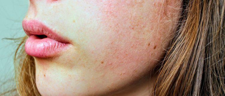 Wat kun je doen tegen een extreem droge huid?