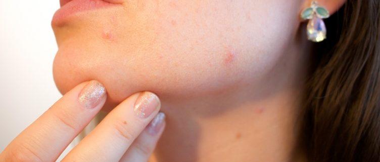 Welke crème werkt goed tegen acne?